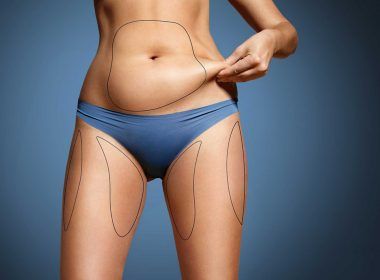 Female body with areas marked for liposuction surgery